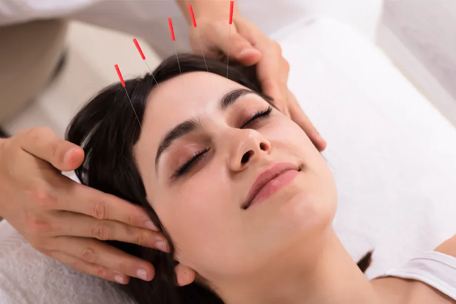 Accupuncture-Clinic A woman receives acupuncture treatment on her forehead. Get acupuncture from Markham Natural Health Centre in Greater Toronto.