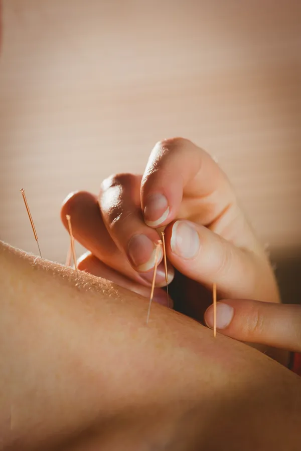Accupuncture-Treatment Close-up of an acupuncture treatment. Get acupuncture from Markham Natural Health Centre in Greater Toronto.