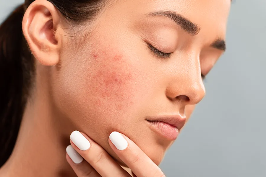 Acne-Clinic Side profile of a woman touching her irritated cheek with visible acne, representing the personalized acne solutions available by Markham Natural Health Centre in Greater Toronto.