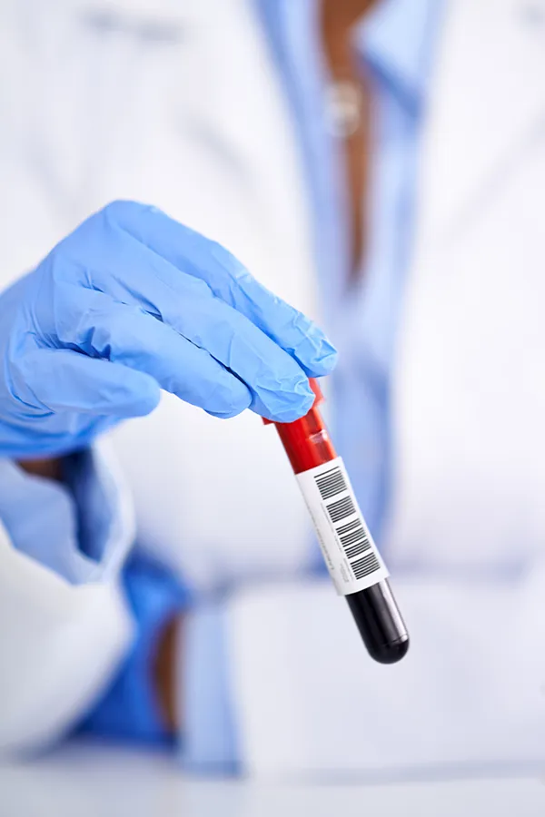 High-Cholesterol-Treatment Close-up of a gloved clinician holding a blood test. Get treatment for high cholesterol from Markham Natural Health Centre in Greater Toronto.