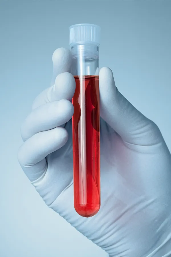 Live-Blood-Cell-Microscopy-Treatment A gloved clinician's hand holding a vial of plasma. Get live blood cell microscopy from Markham Natural Health Centre in Greater Toronto.