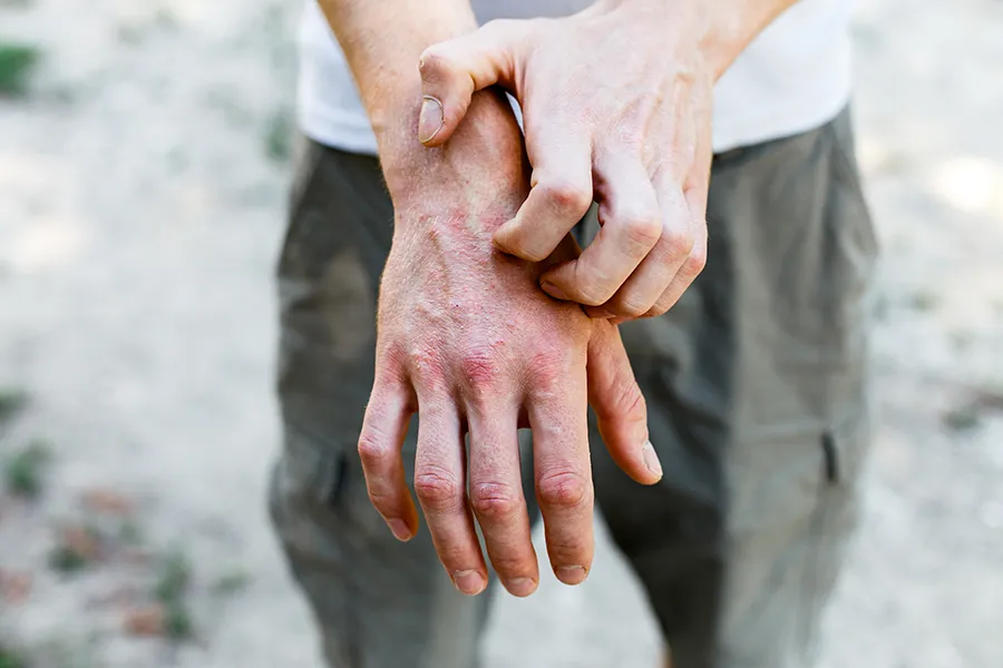 Psoriasis-Clinic Close-up of a man scratching his hands while experiencing Psoriasis. Get care for Psoriasis from Markham Natural Health Centre in Greater Toronto.