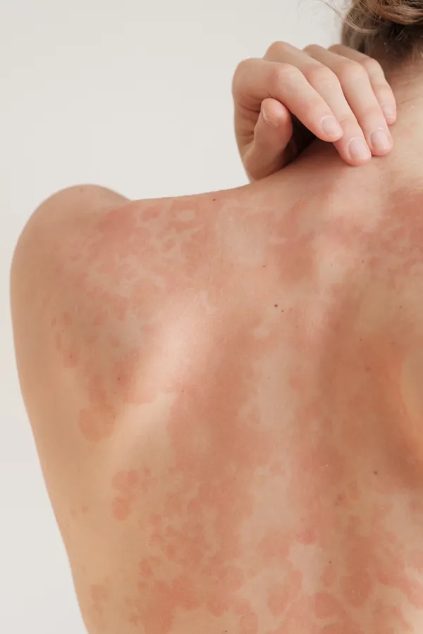 Psoriasis-Treatment The back and shoulder of a woman experiencing Psoriasis. Get treatment for Psoriasis from Markham Natural Health Centre in Greater Toronto.