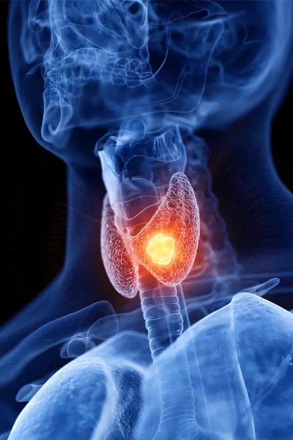 Thyroid-Imbalance-Treatment A 3D illustration of an x-ray of a human neck, highlighting the thyroid. Get help with thyroid imbalance from Markham Natural Health Centre in Greater Toronto.