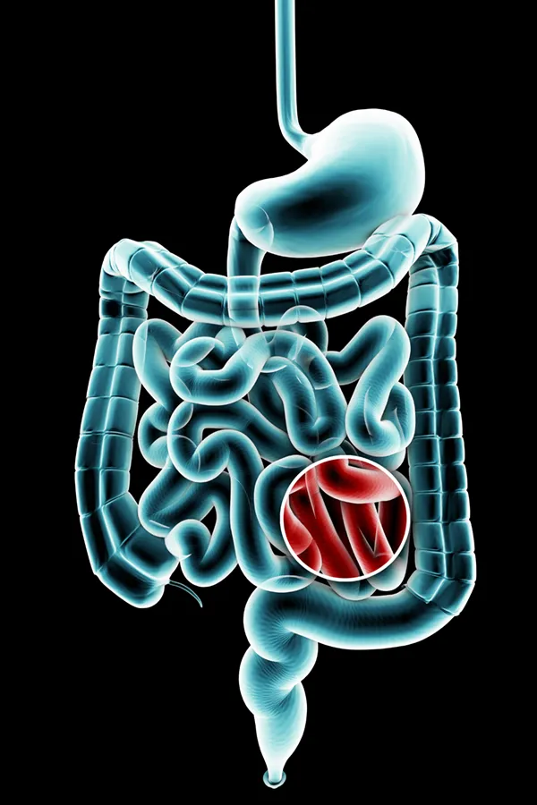 Ulcerative-Colitis-Treatment 3D illustration of the digestive system in blue tones, with an area of discomfort in red tones. Get treatment for Ulcerative Colitis from Markham Natural Health Centre in Greater Toronto.